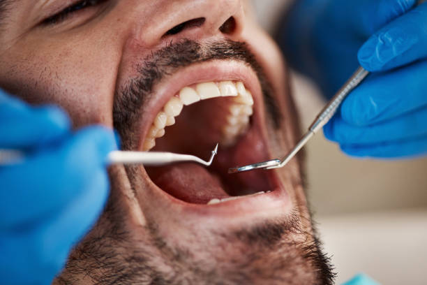Best Emergency Treatment for Dental Infections or Abscesses in Del Rey, CA